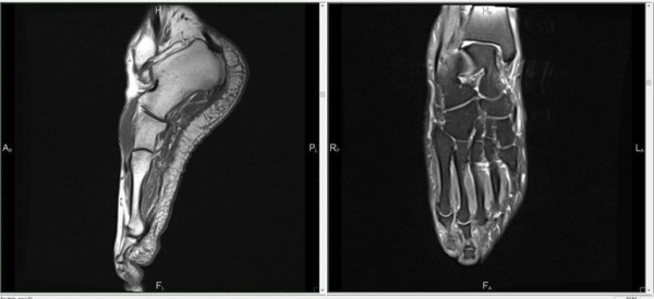 Что показывает МРТ стопы и голеностопного сустава